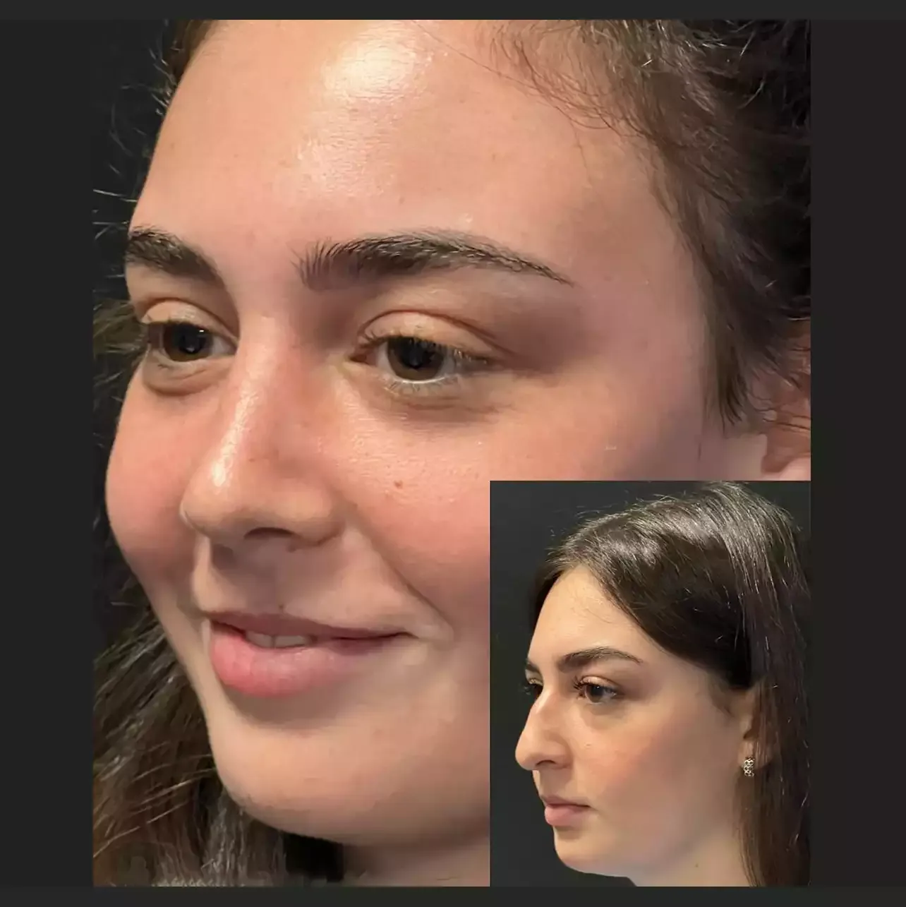 How to Prepare for Rhinoplasty in Dubai Successfully