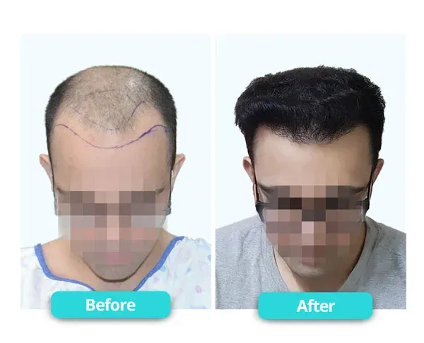 زراعة الشعر للنساء في دبي: استعيدي كثافة شعرك وأنوثتك