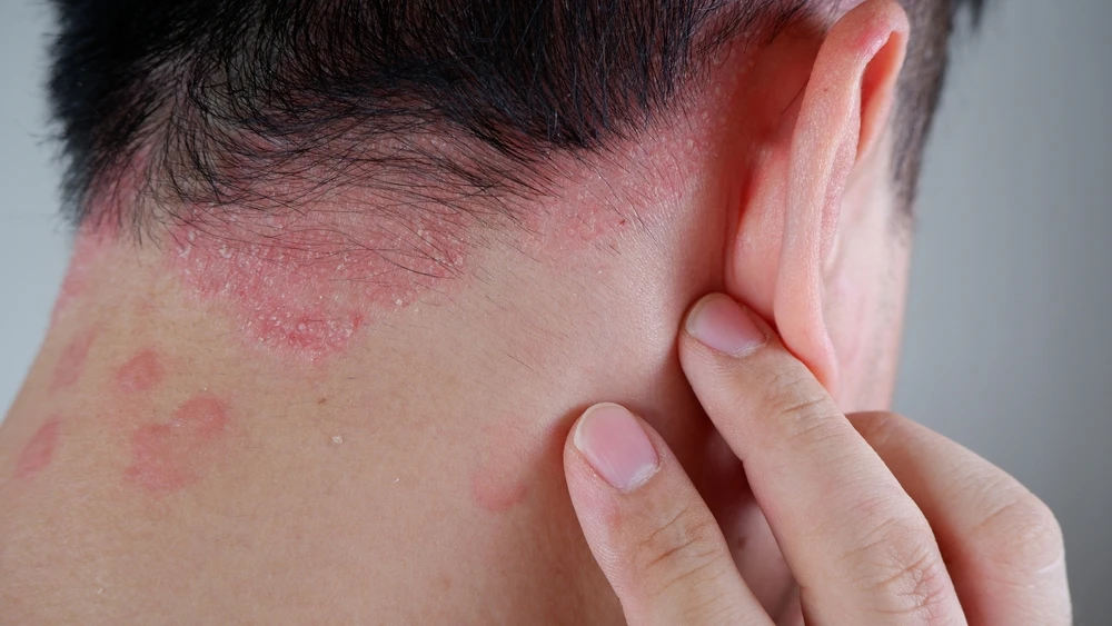 Is Psoriasis Contagious?