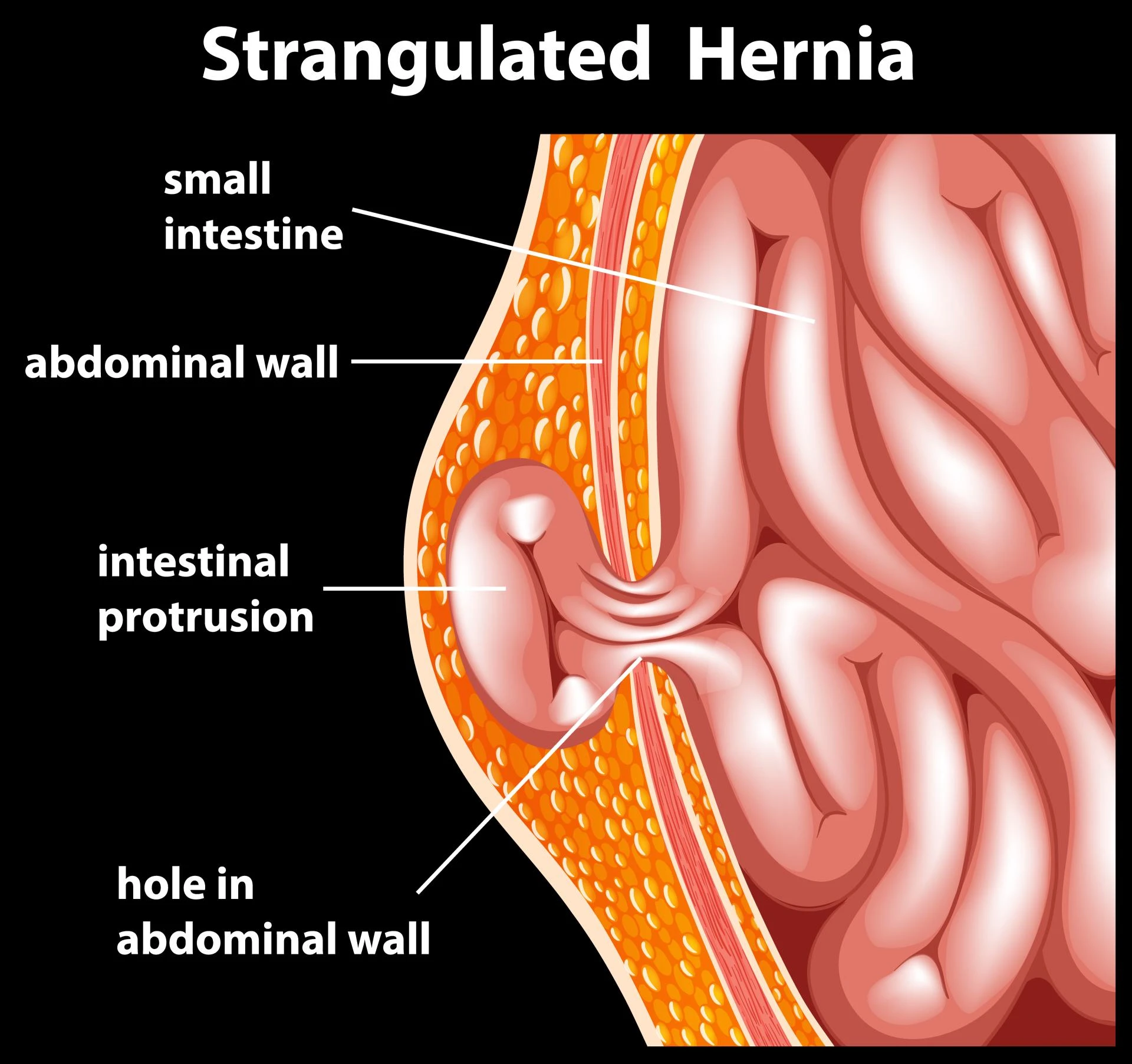 Hernia: Causes, Symptoms & When to Seek Surgery