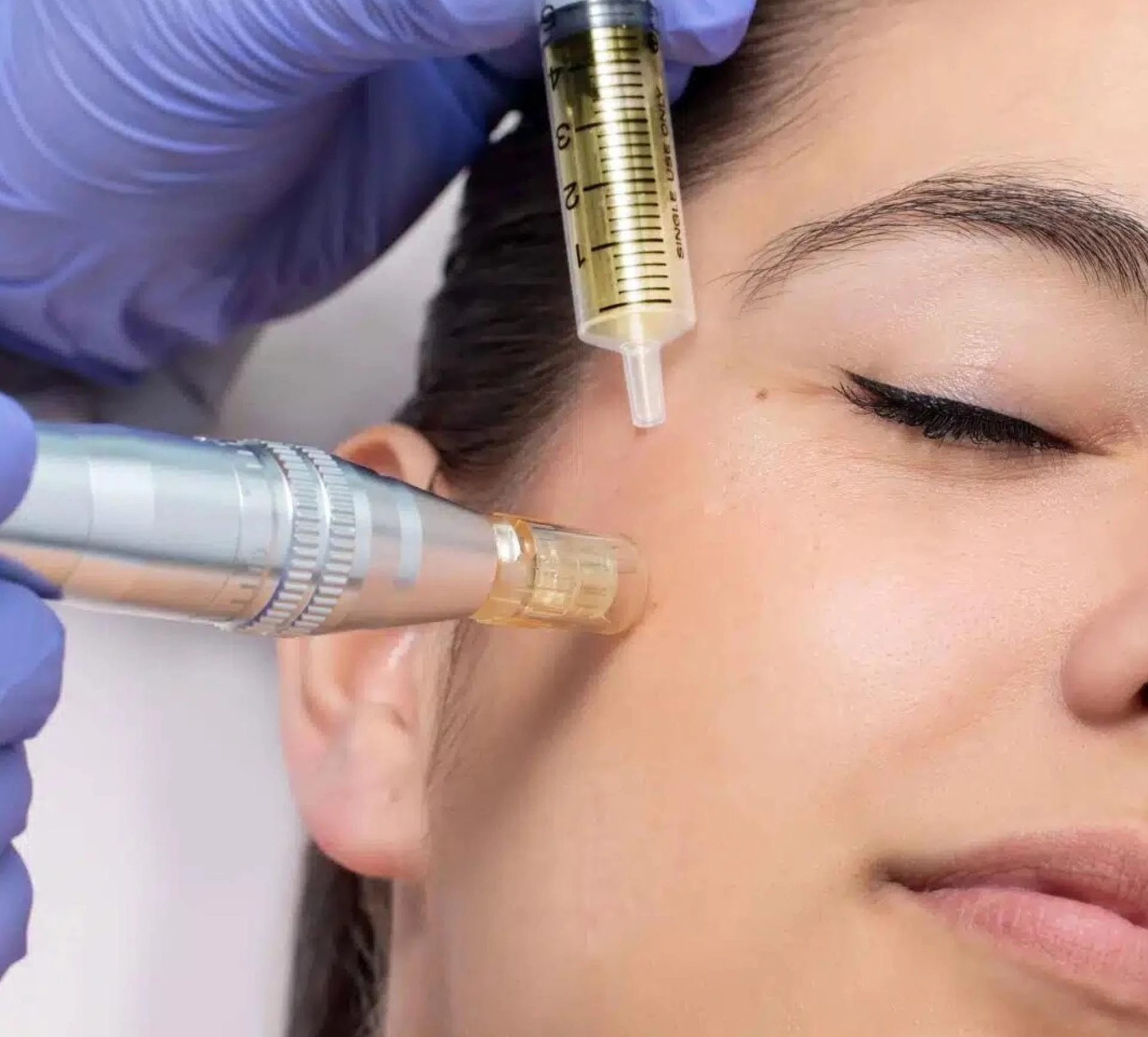 What are the Effective Treatments for Acne Scars?