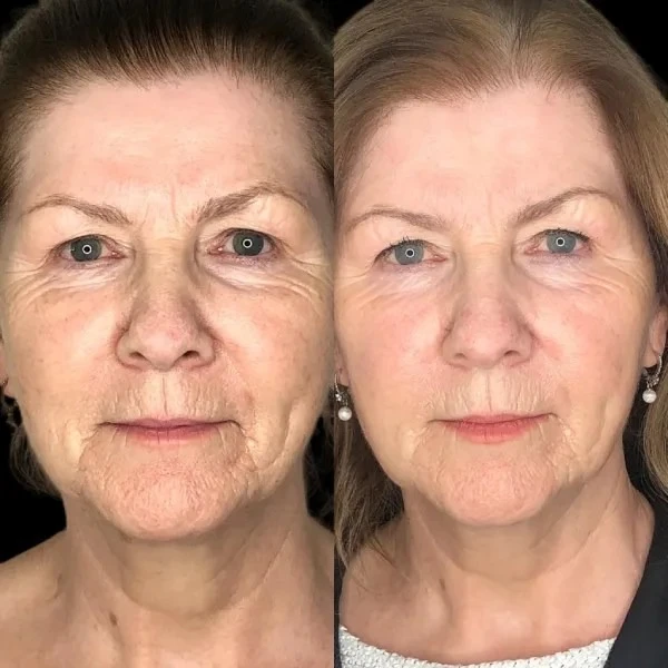 Best Plastic Surgeons in dubai Specializing in Profhilo