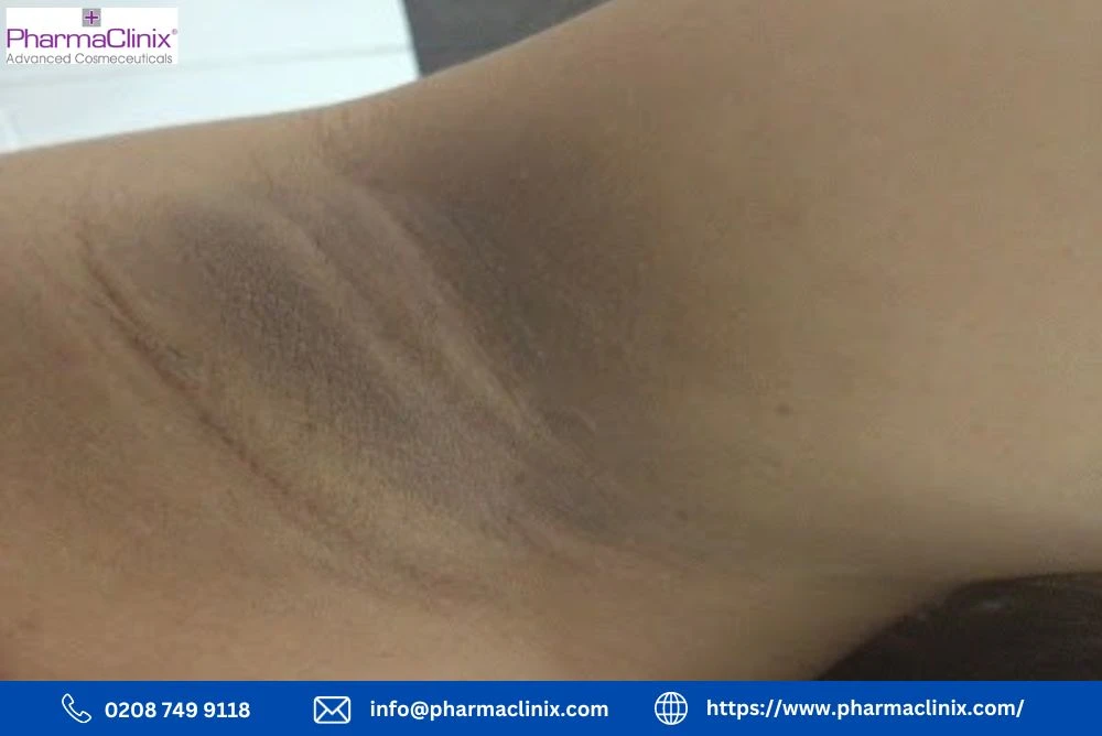 Dark Patches in Armpits: Causes, Treatments, Natural Remedies & Prevention Tips for Even Skin