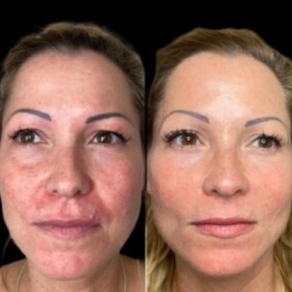 Unveil Fresh Skin through Profhilo Treatment in Dubai