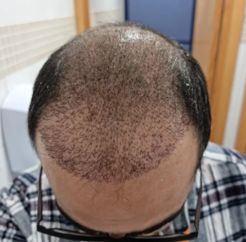 Faster, Safer, Better: New Frontiers in Hair Transplant Healing