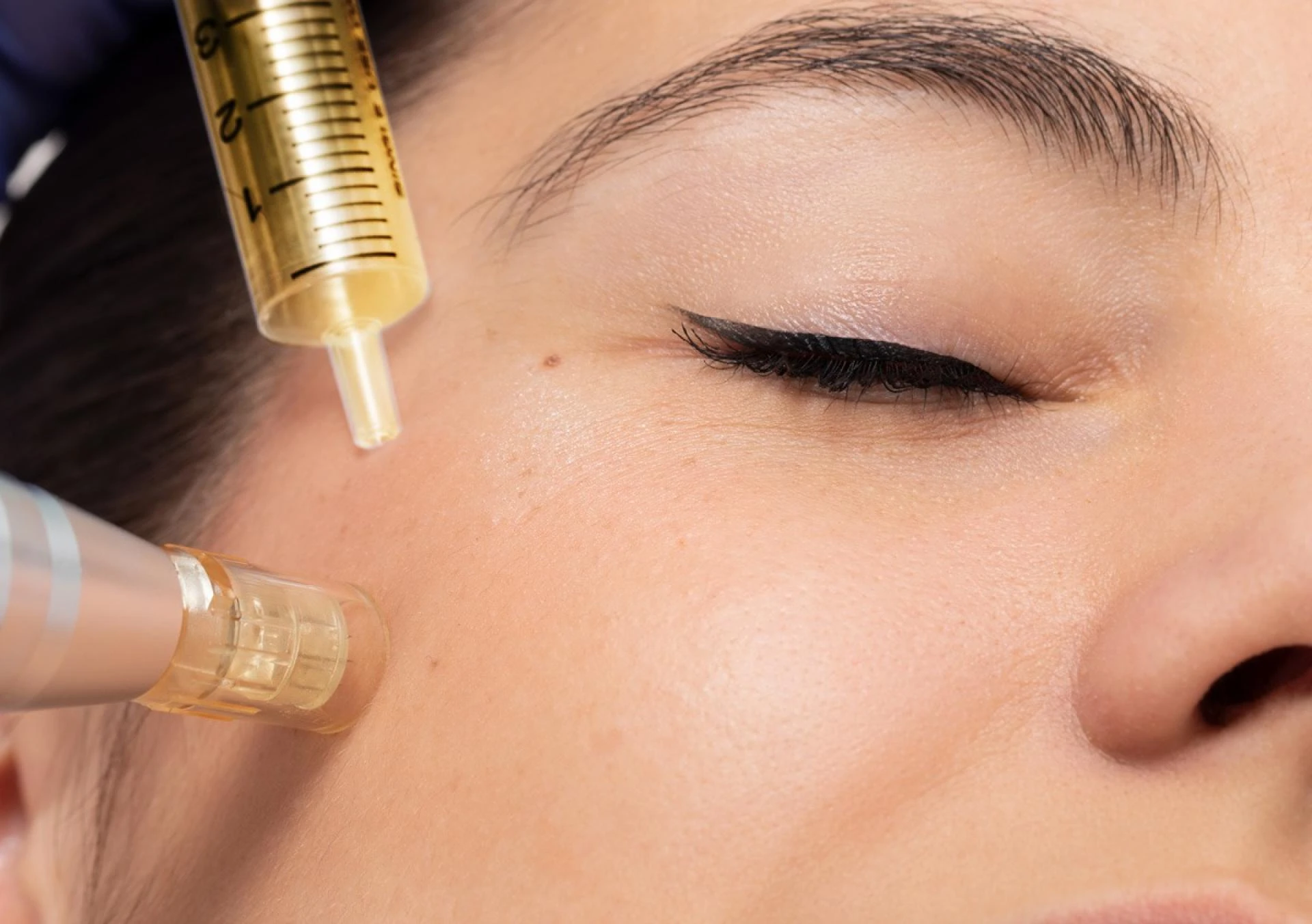 Microneedling Treatment in Delhi: Reverse Scars, Wrinkles, and Pigmentation