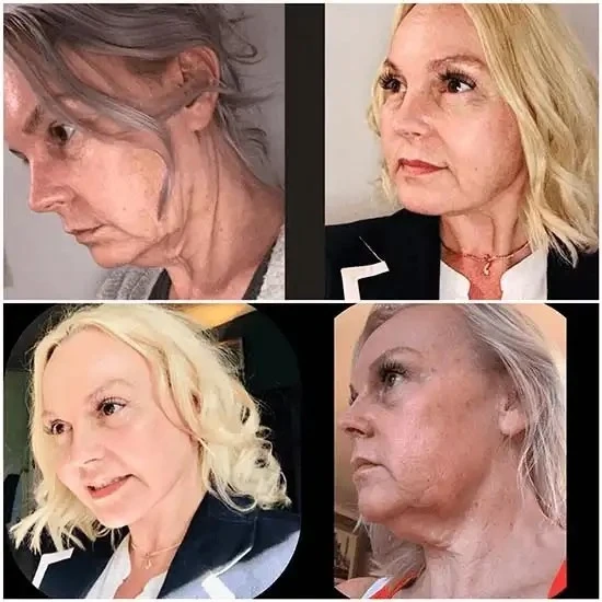 Mold Radiance with Profhilo from the Best Doctors in dubai