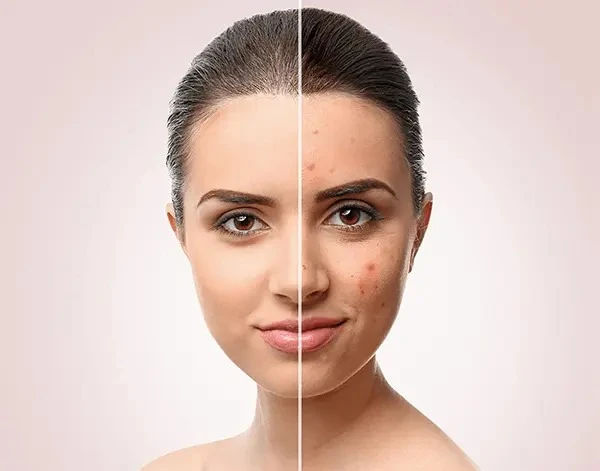 Best Acne Scar Treatment in Delhi – Get Results That Last