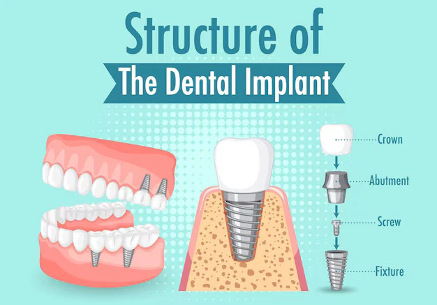 Are Dental Implants Procedure Painful? Here’s the Real Answer