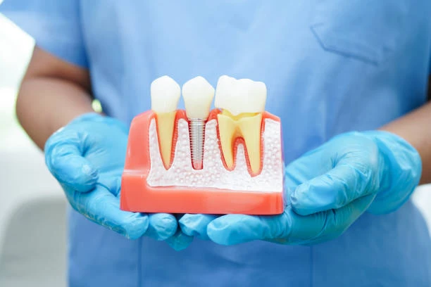 Are Dental Implants Procedure Painful? Here’s the Real Answer