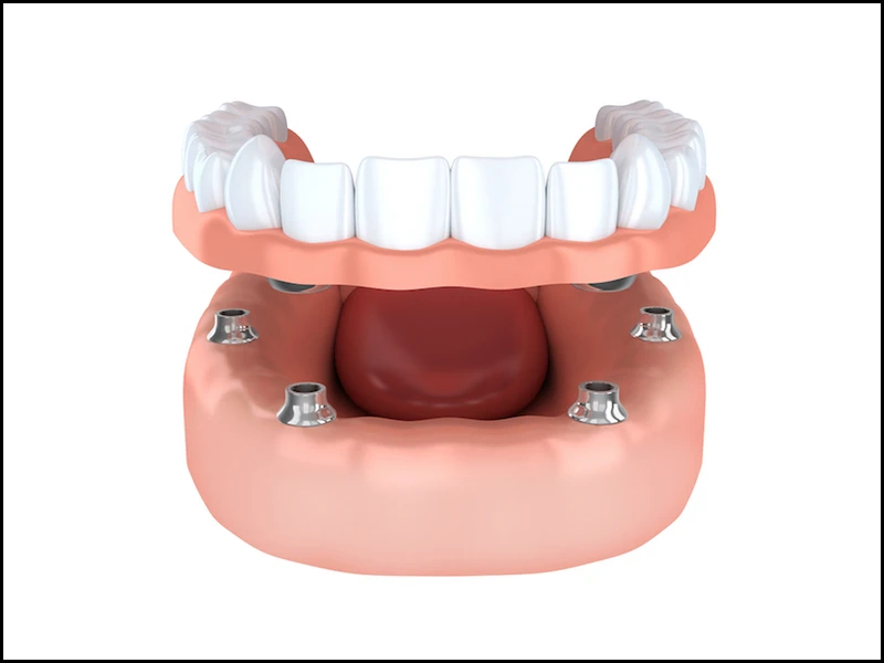What Is Implant Supported Overdenture?
