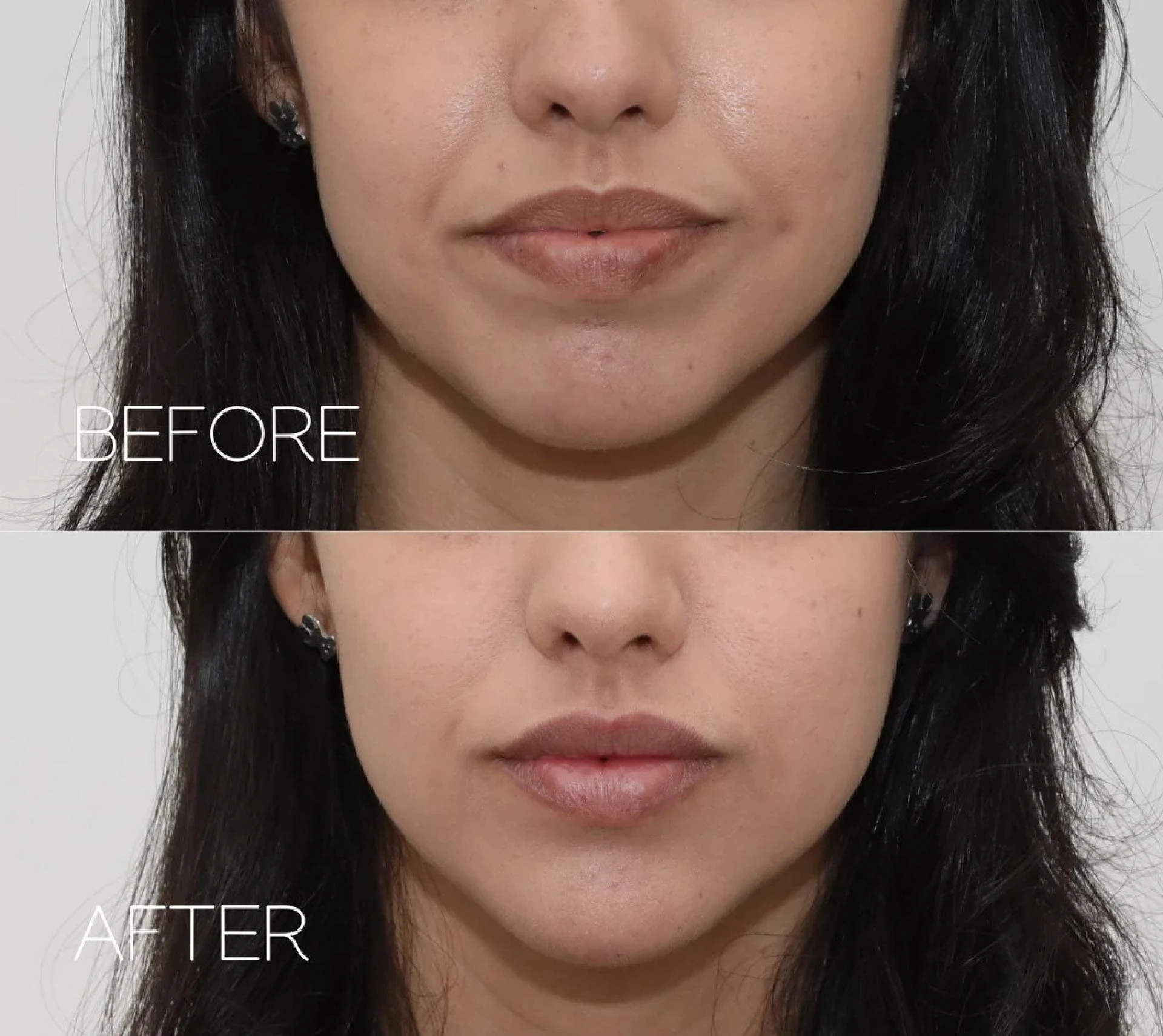 How PRF Lips and EZ Gel Deliver Stunning Results: Before and After Comparisons