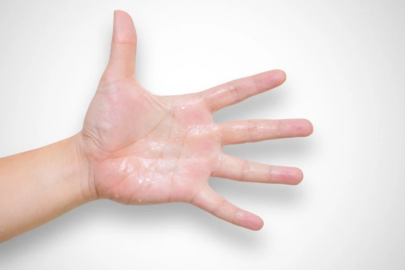 Hyperhidrosis Treatment in Delhi: Safe and Effective Iontophoresis for Sweaty Hands and Feet