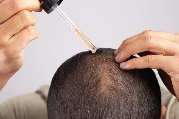 Hair Loss Treatment Delhi: Medical Insights on Modern Therapies