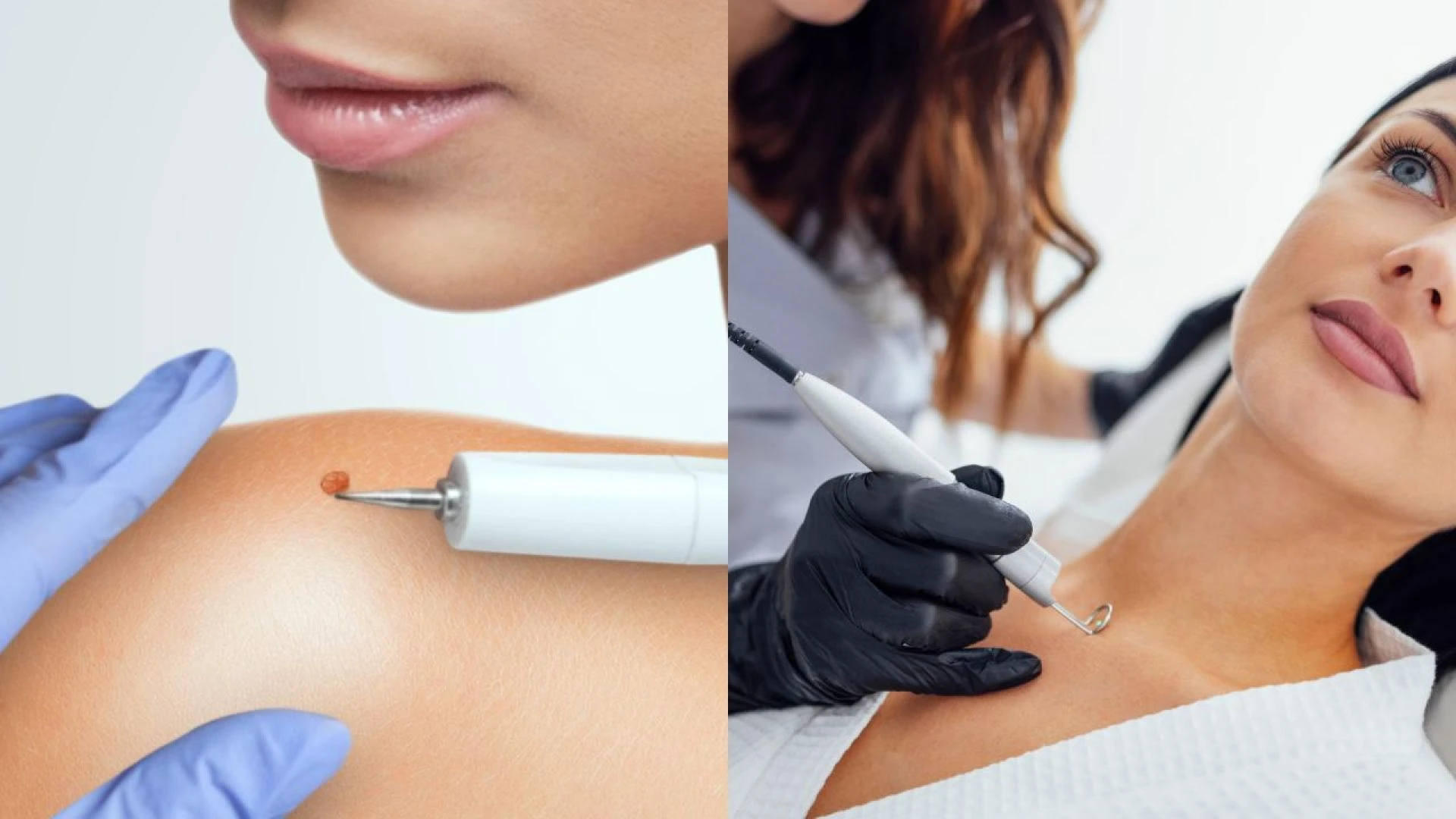 Find Expert Mole Removal Near Me for Clearer Skin