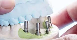 Are Dental Implants Right for Seniors?