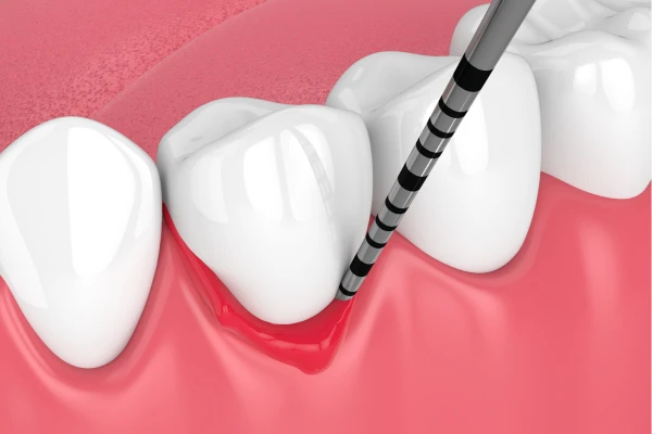 Signs You May Need Periodontal Treatment Immediately