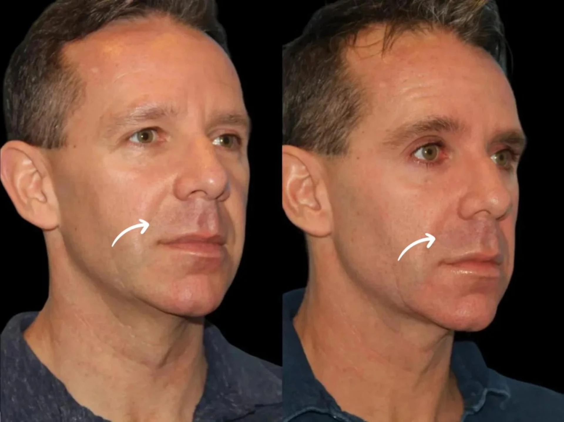 Sculptra Reviews from Best Plastic Surgeons in Dubai