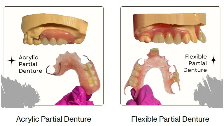 Choosing the Right Tooth Replacement: What You Should Know