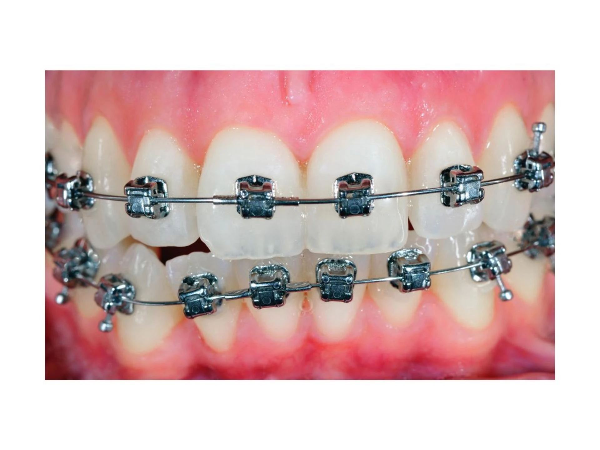 How 3D Imaging Powers Invisalign in North York