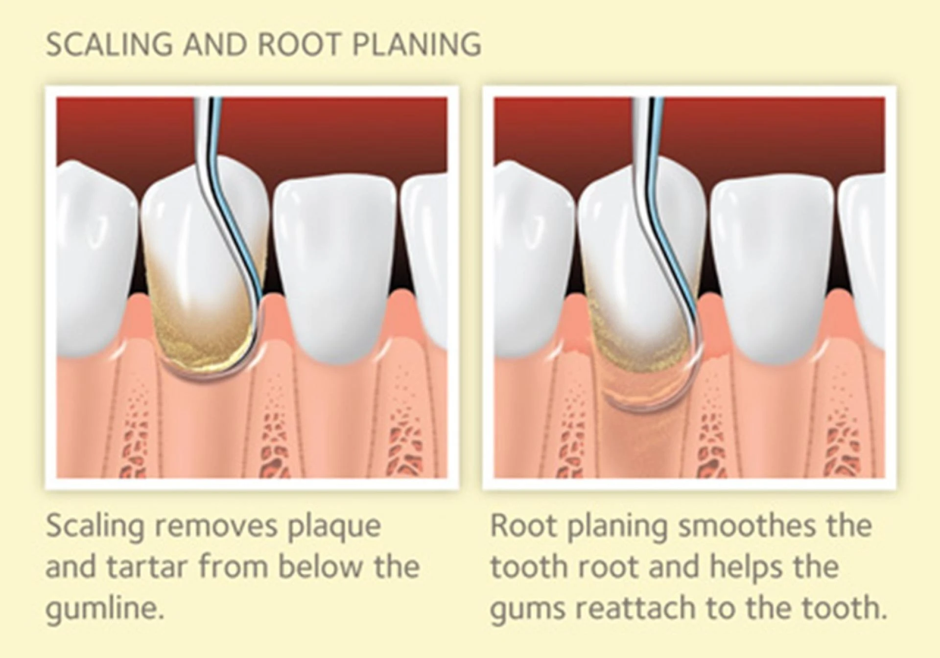 What Is Periodontal Disease Treatment ?