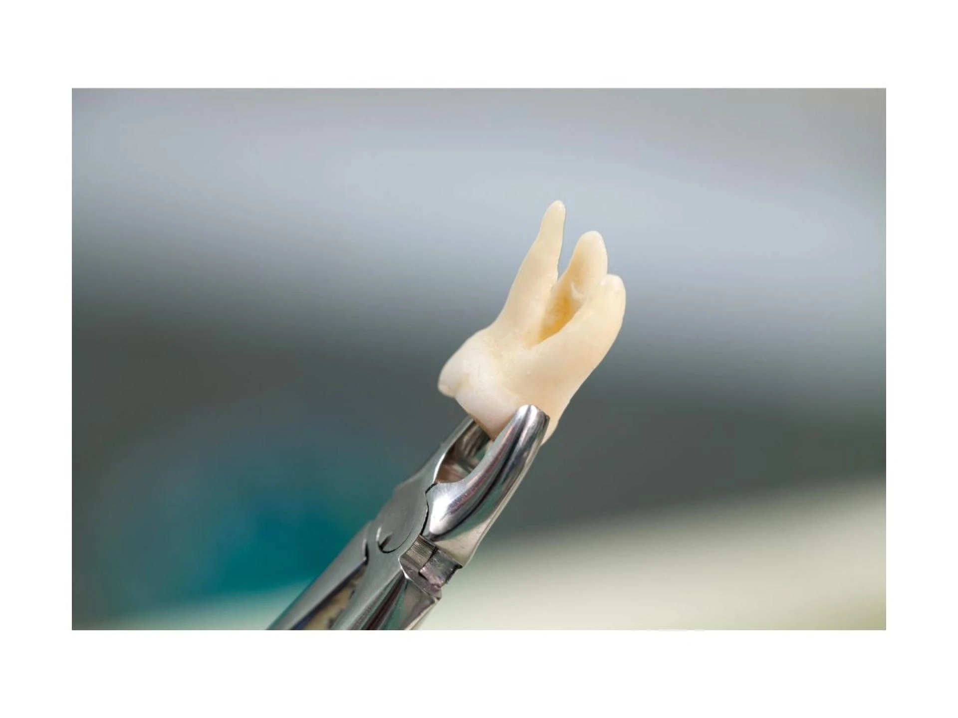 Stress-Free Wisdom Teeth Removal with Modern Sedation