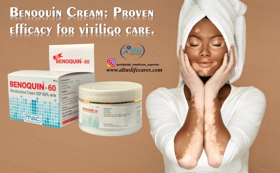 Benoquin 60 Cream – Smooth, Repigmented Skin in Weeks